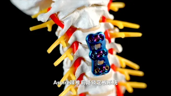 전방 경추 플레이트 척추 임플란트 경추 고정